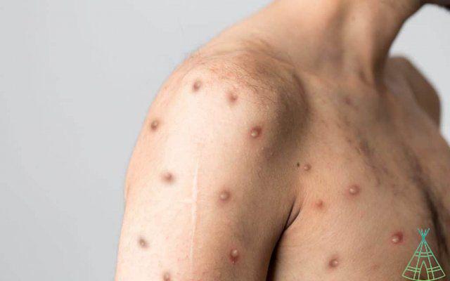 ¿Es viruela o varicela? Saber diferenciar