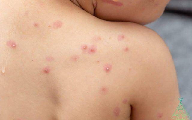 ¿Es viruela o varicela? Saber diferenciar
